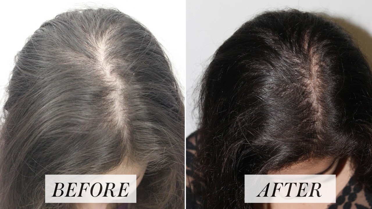 Affordable Payment Plans for Hair Transplant London